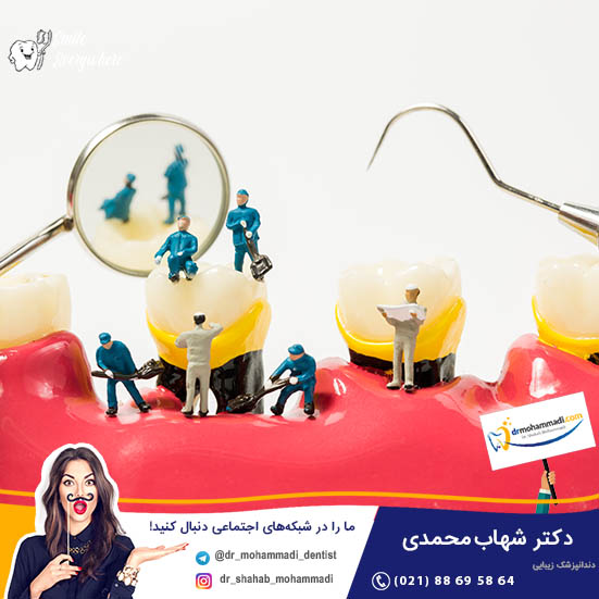 عوارض کوتاه مدت یا بلند مدت ایمپلنت دندان و آسیب به لثه ها - کلینیک دندانپزشکی دکتر شهاب محمدی